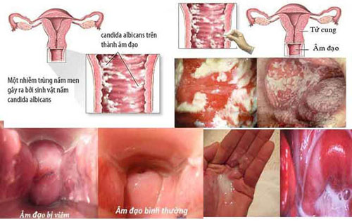 Nguyên nhân gây nên tình trạng viêm âm đạo