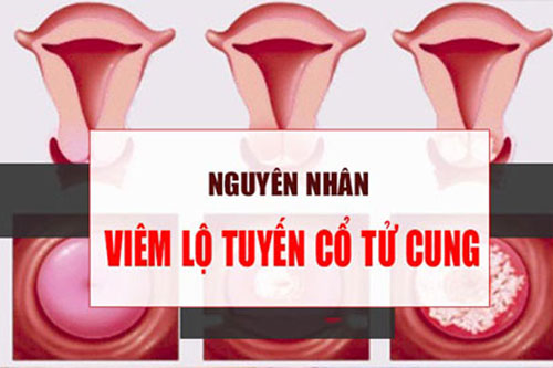 Nguyên nhân gây viêm lộ tuyến cổ tử cung