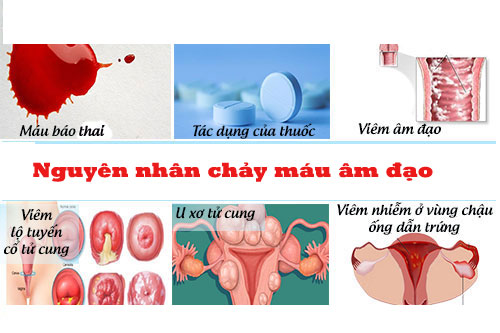 Nguyên nhân nào gây nên chảy máu âm đạo