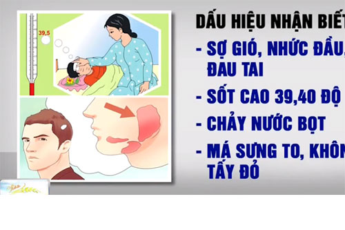 Nhận biết các triệu chứng quai bị thường gặp