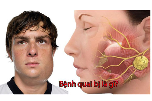Quai bị là gì? Nguyên nhân quai bị và con đường lây nhiễm