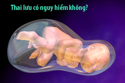 Thai lưu có nguy hiểm không? Thai lưu có nguy hiểm không?