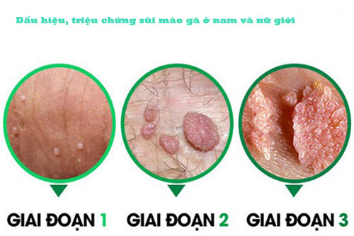 Triệu chứng sùi mào gà