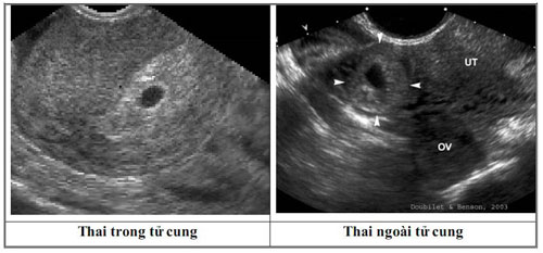 Xuất huyết tử cung bất thường có nguy hiểm không