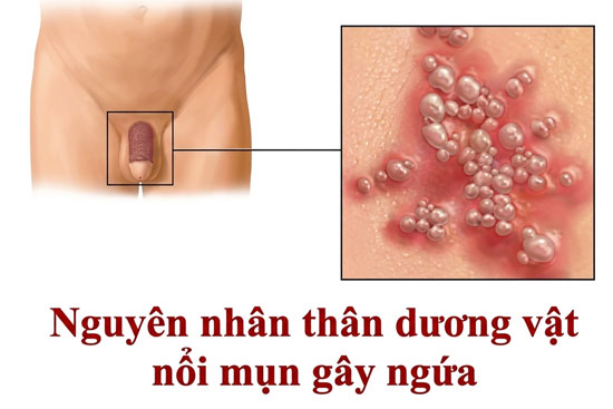 Thân dương vật nổi mụn trắng, mụn đỏ gây ngứa là bệnh gì